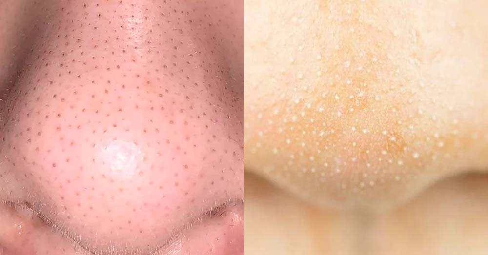 ब्लैकहेड्स बनाम व्हाइटहेड्स: क्या है फर्क और कैसे करें इलाज?