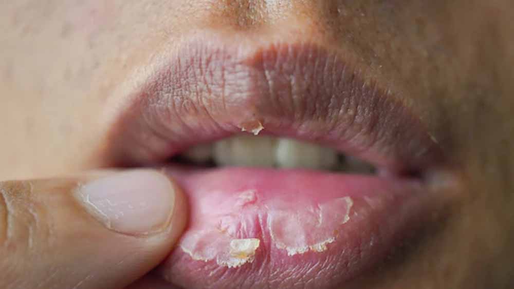 सर्दी और बदलते मौसम में होंठ बेजान? इन घरेलू उपायों से पाएं खूबसूरती