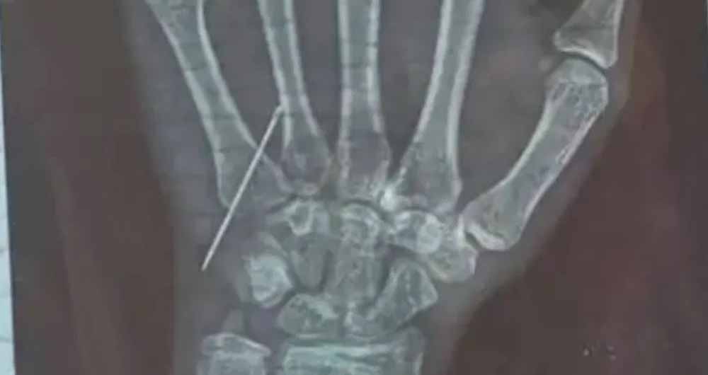 MBBS डॉक्टर को नहीं आता इंजेक्शन लगाना, गोरखपुर में 15 वर्षीय बच्ची बनी शिकार