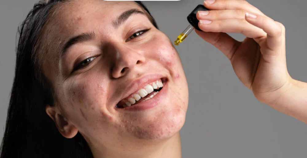 ऐसे करें सैलिसिलिक एसिड का इस्तेमाल, चेहरे से पिंपल्स होंगे गायब