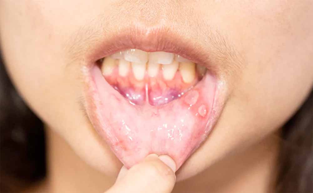 बार-बार होने वाले मुंह के छाले? अपनाएं ये सरल इलाज